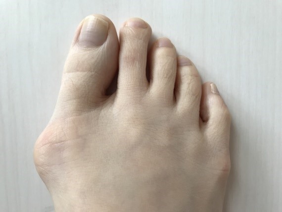 コラム２ あなたの足の親指 曲がっていませんか 外反母趾 インソールで足から健康な体を作るbmz