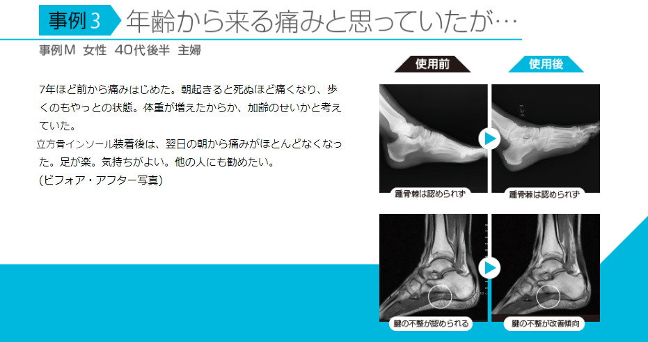 足底筋膜炎に関するインソールの研究成果 | インソールで足から健康