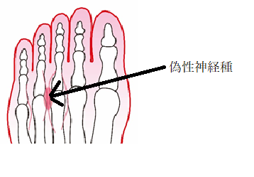 コラム７ 足指の間がピリピリ チクチク モートン病 インソールで足から健康な体を作るbmz